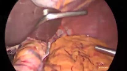 Endoscopic Metabolic Surgery Using IMAGE1 S