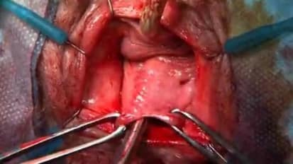 Paravaginal of Transverse Cystocele Repair with Suspend® Fascia Lata® - Andrew Cassidenti, MD