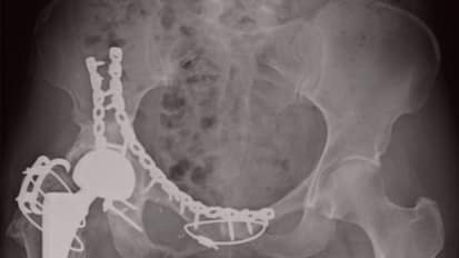 Solitary Fibrous Tumor of the Pelvis and Acetabulum