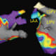 Posterior views of the left atrium before and after Convergent atrial fibrillation ablation