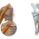 Figure 1: Gracilis functional free muscle transfer surgery involves transferring the gracilis muscle from the medial thigh to the upper arm to restore function in patients with brachial plexus injuries. The gracilis offers a rich source of vascular and nervous tissue and its transfer results in minimal morbidity and function loss at the donor site.