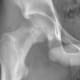 Figure 1: Radiograph of the right proximal femur showing high-grade osteosarcoma.