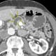 Medical imaging shows an intraductal papillary mucinous neoplasm (IPMN), a dark gray area highlighted by yellow arrows