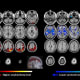 Image from a Johns Hopkins Medicine study showing PET scans from brains of people with and without late-life depression. The brains of patients with late-life depression show more yellow to red regions (scans on the left), indicating higher amyloid beta protein levels, and more blue regions (scans on the right), indicating lower serotonin transporter levels. Both imaging measures are markers of late-life depression. Credit: Graphic adapted from Smith et al, Nature, Sept. 13, 2021