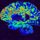 MRI image in false colors of a brain hemisphere from a patient with multiple sclerosis. Areas affected by the autoimmune disease are shown in red. Credit: MRI image courtesy of Govind Bhagavatheeshwaran and Daniel Reich, National Institute of Neurological Disorders and Stroke, National Institutes of Health