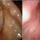 Photos show posterior glottic stenosis from long-term intubation, treated with laser excision, dilation and steroid injection. After treatment (on right), the glottic opening is much better. The patient’s tracheotomy was removed, and voice and breathing improved.