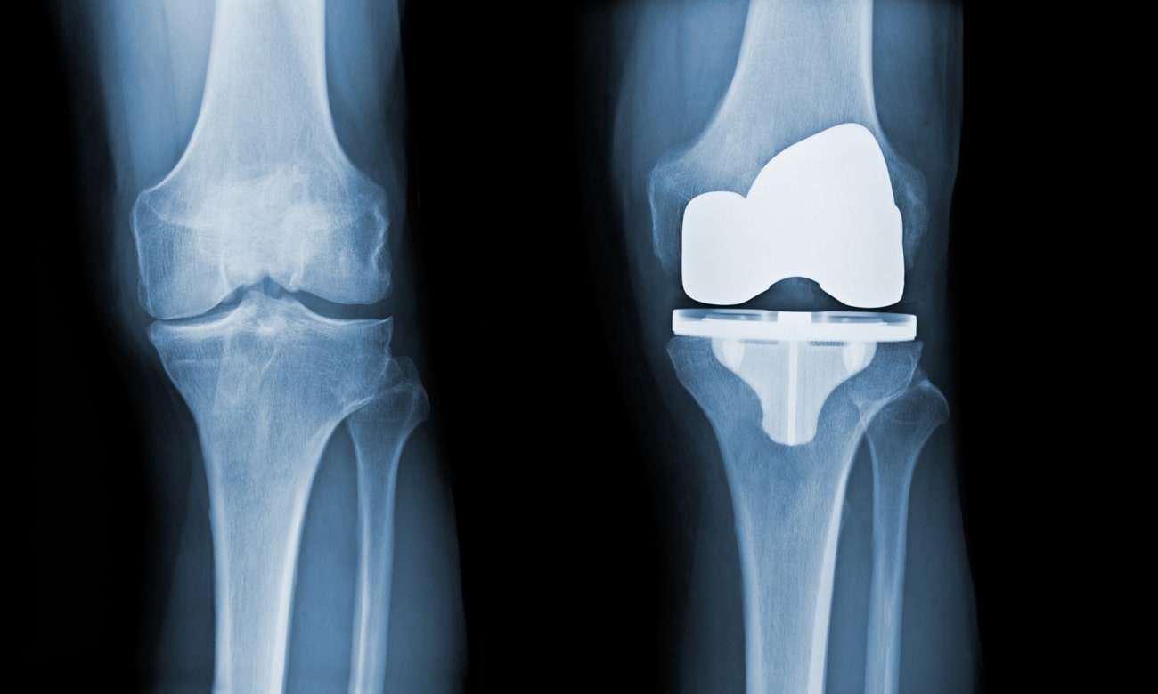 Before and after X-rays of a total knee replacement