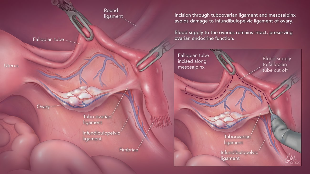 A medical illustration details the steps of a salpingectomy procedure.