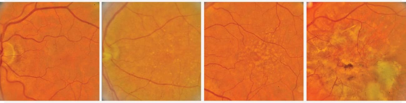 macular degeneration