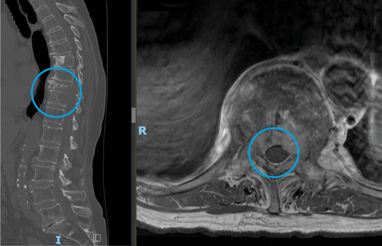 A CT image shows two fractured vertebrae in the spine, and an MRI image shows a tumor inside one of the vertebrae. 