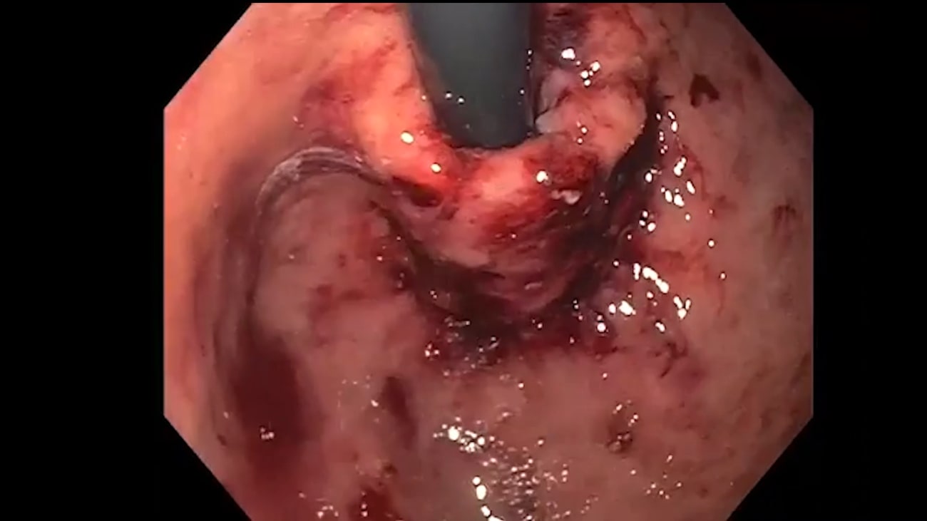 achalasia endoscopy