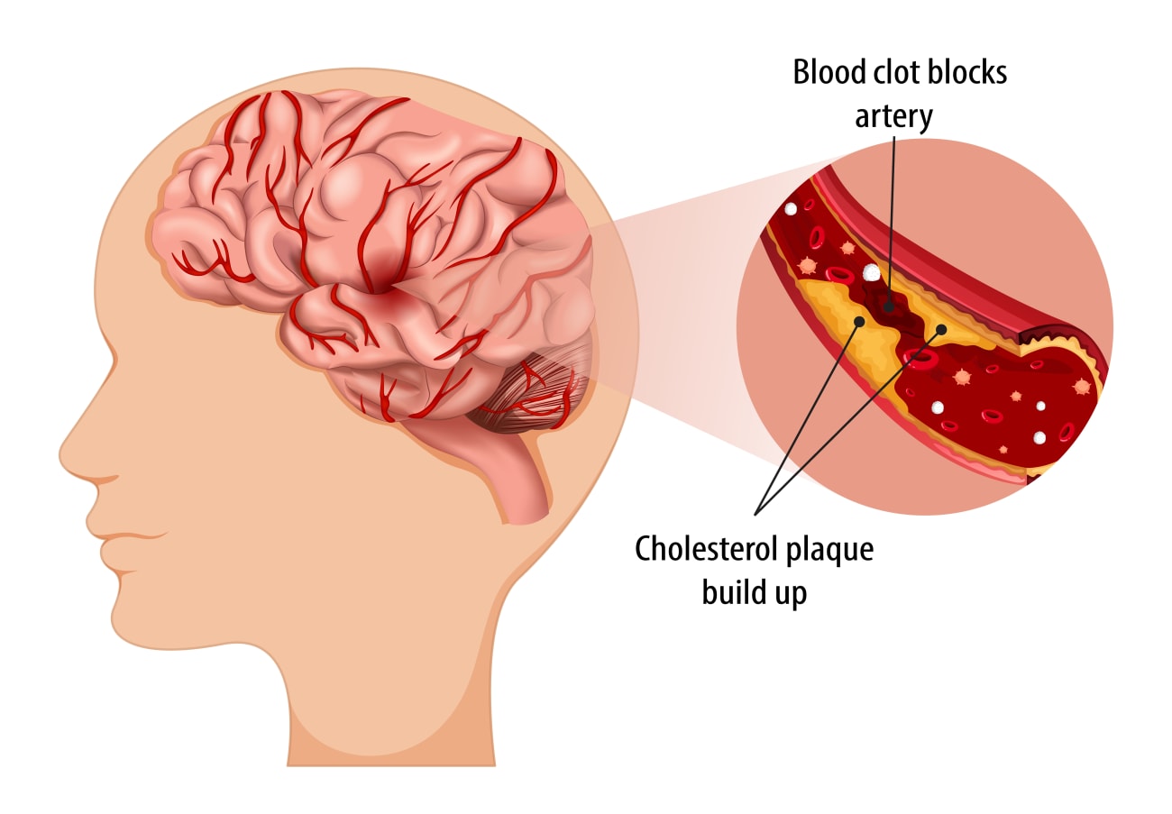 Ischemic Stroke (Clots)  American Stroke Association