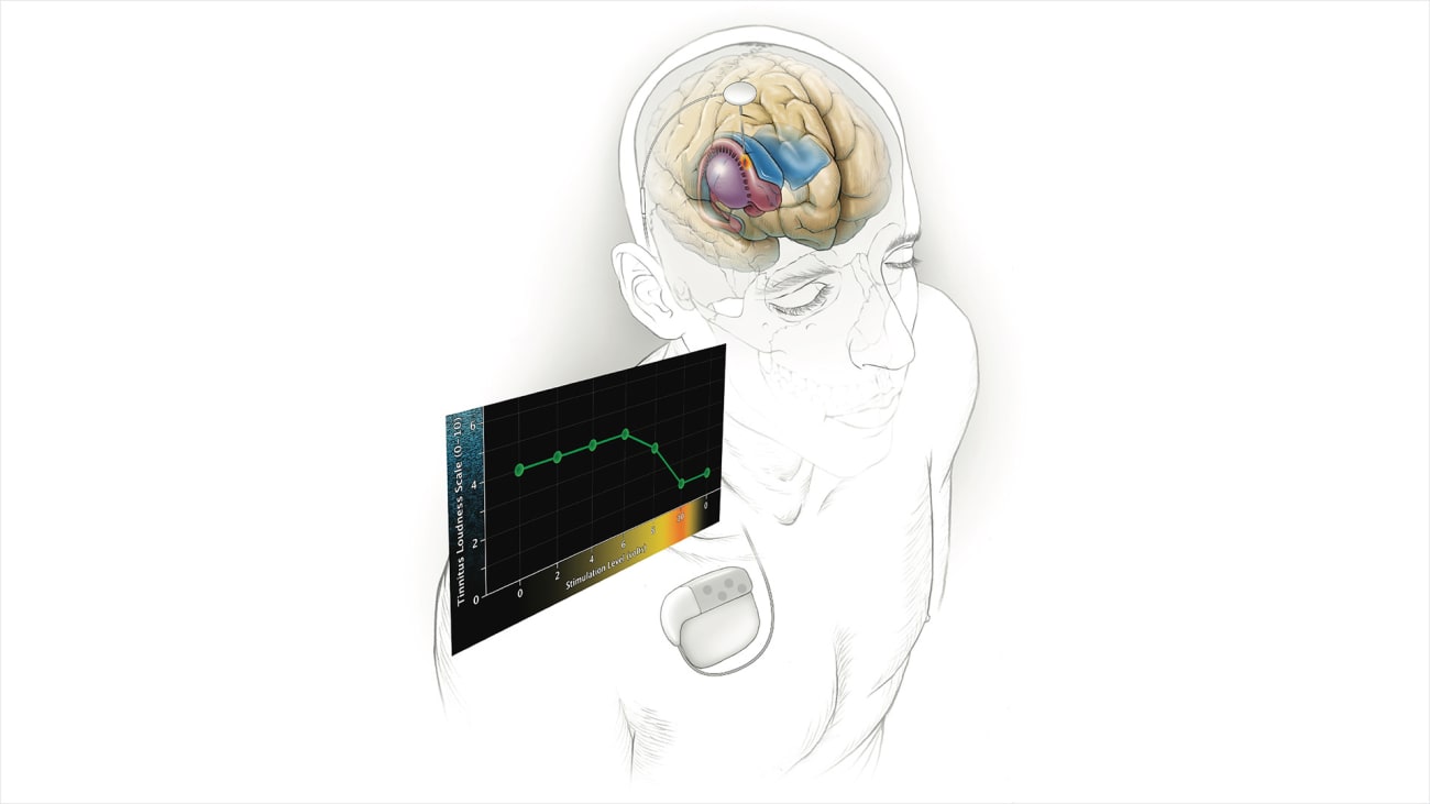 New Tinnitus Research Focused on Neural Networks Shows Promise for