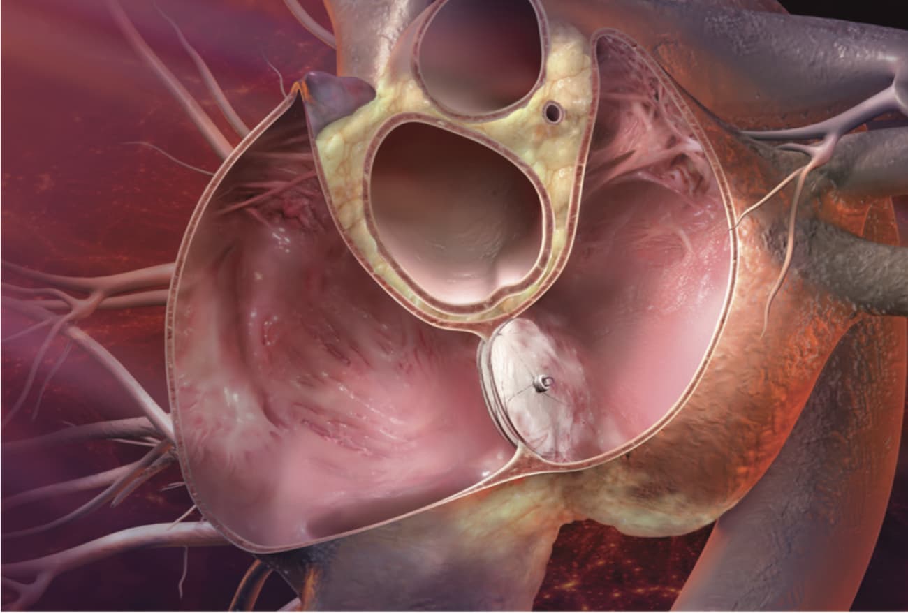 Healing a Hole in the Heart The Medical University of South Carolina