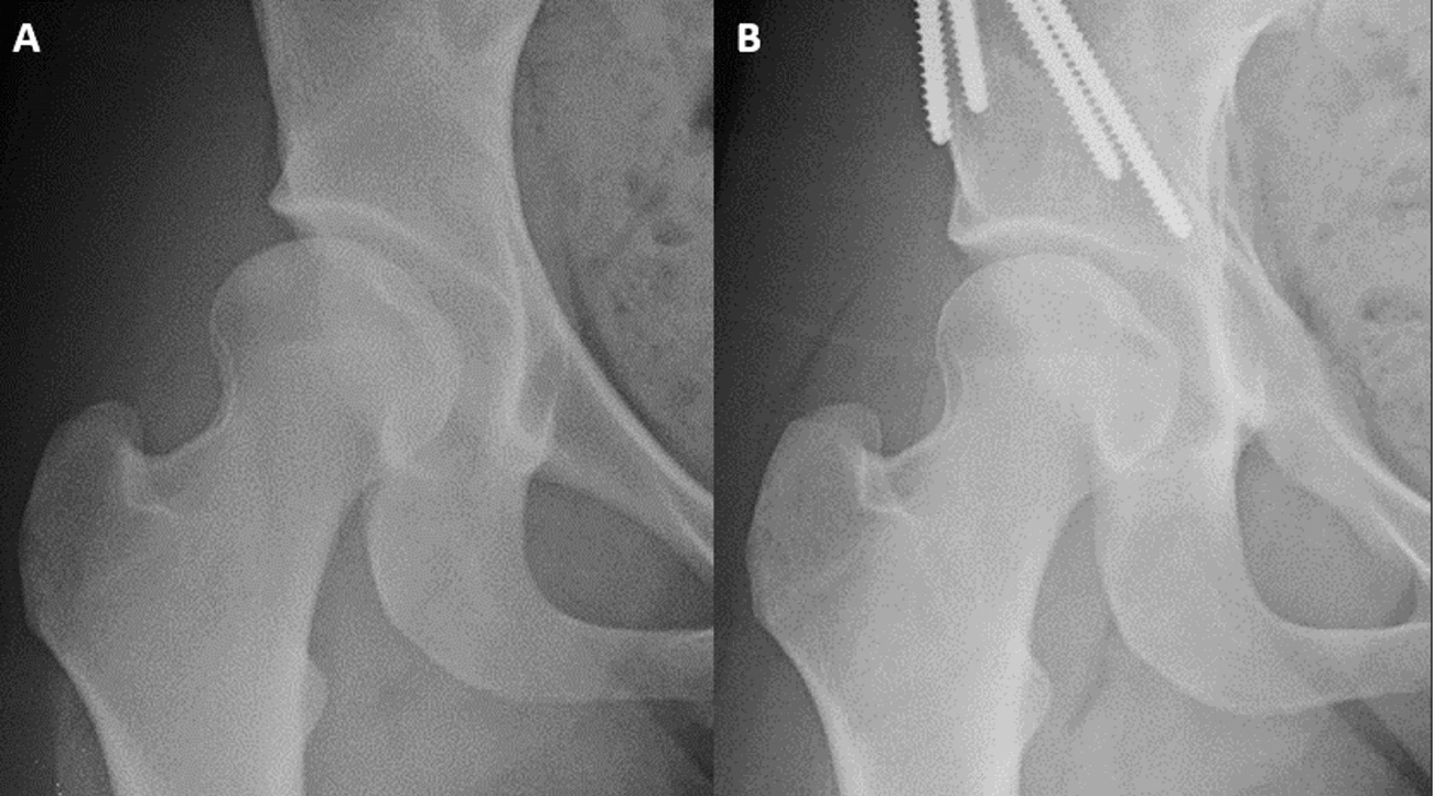 Joint Preservation Surgery Shows Promise in Young Adults with Hip