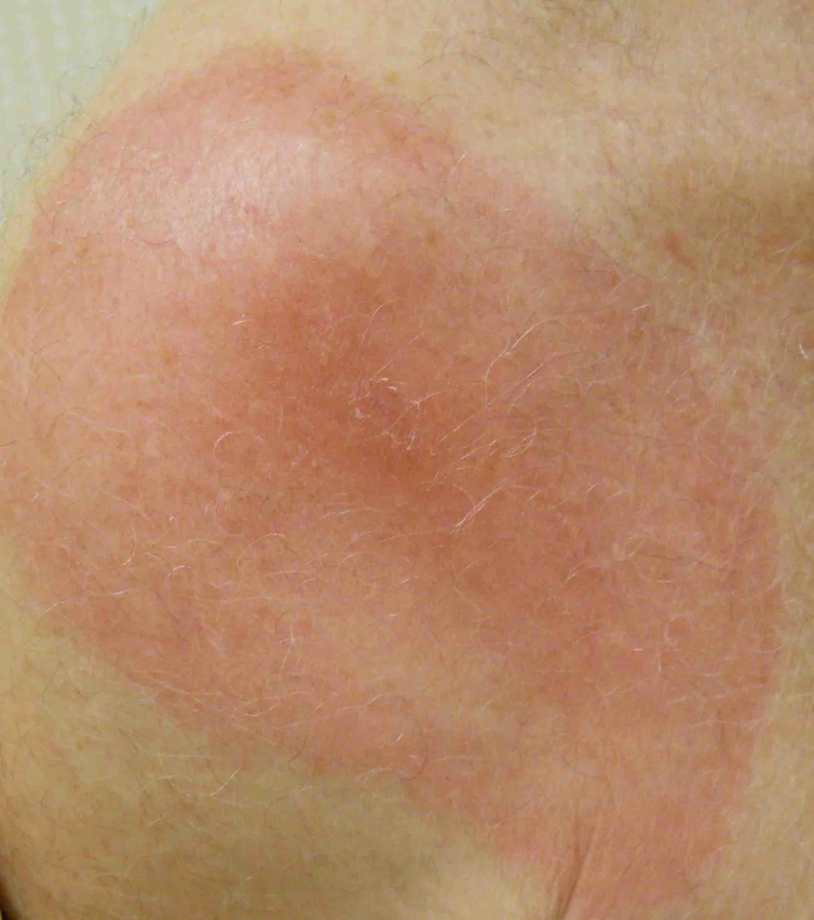 Deep Machine Learning Can More Accurately Identify Erythema Migrans