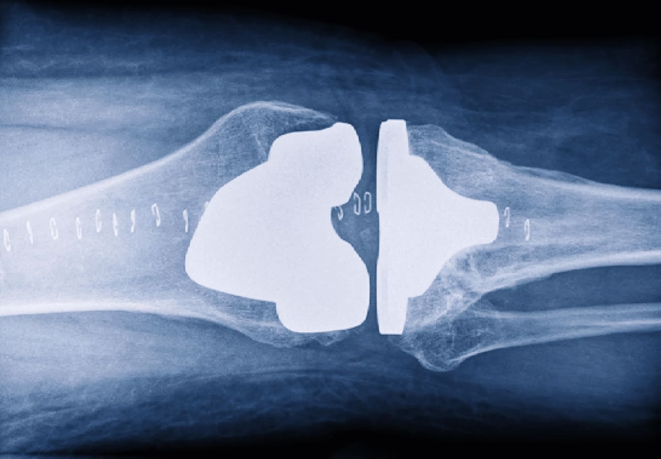 AwardWinning Research Questions the Rationale of NickelFree Total