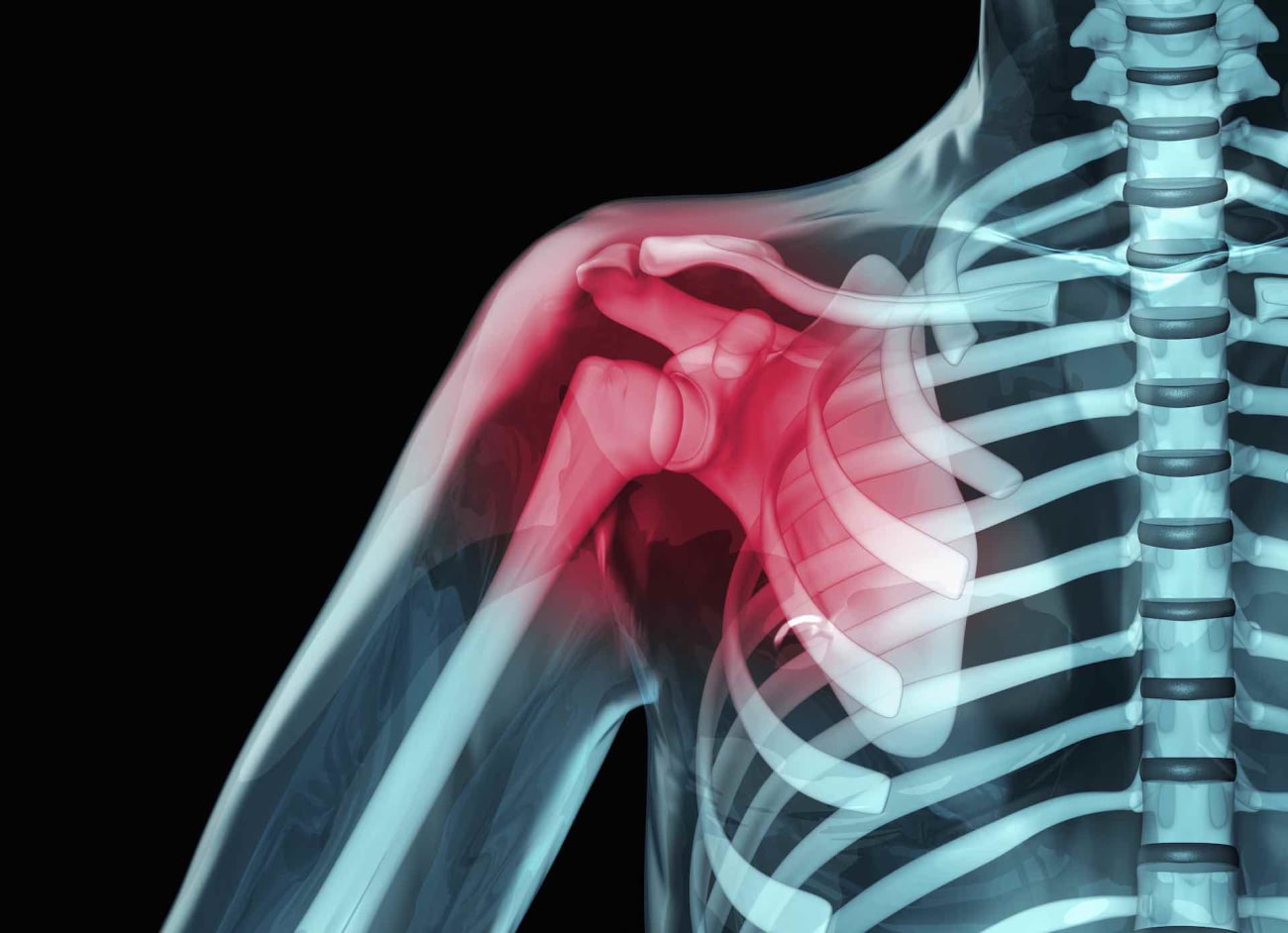 ct arthrography shoulder
