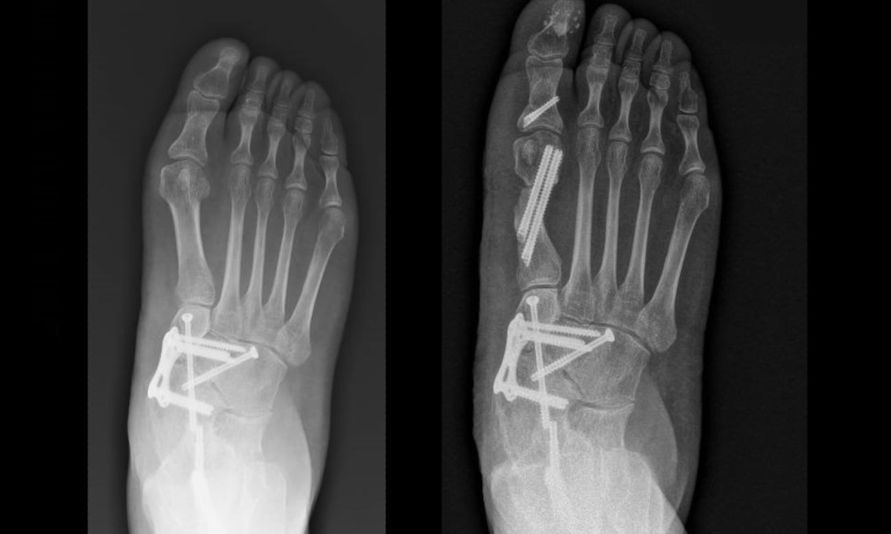 Embracing a Minimally Invasive Philosophy in Foot and Ankle Surgery