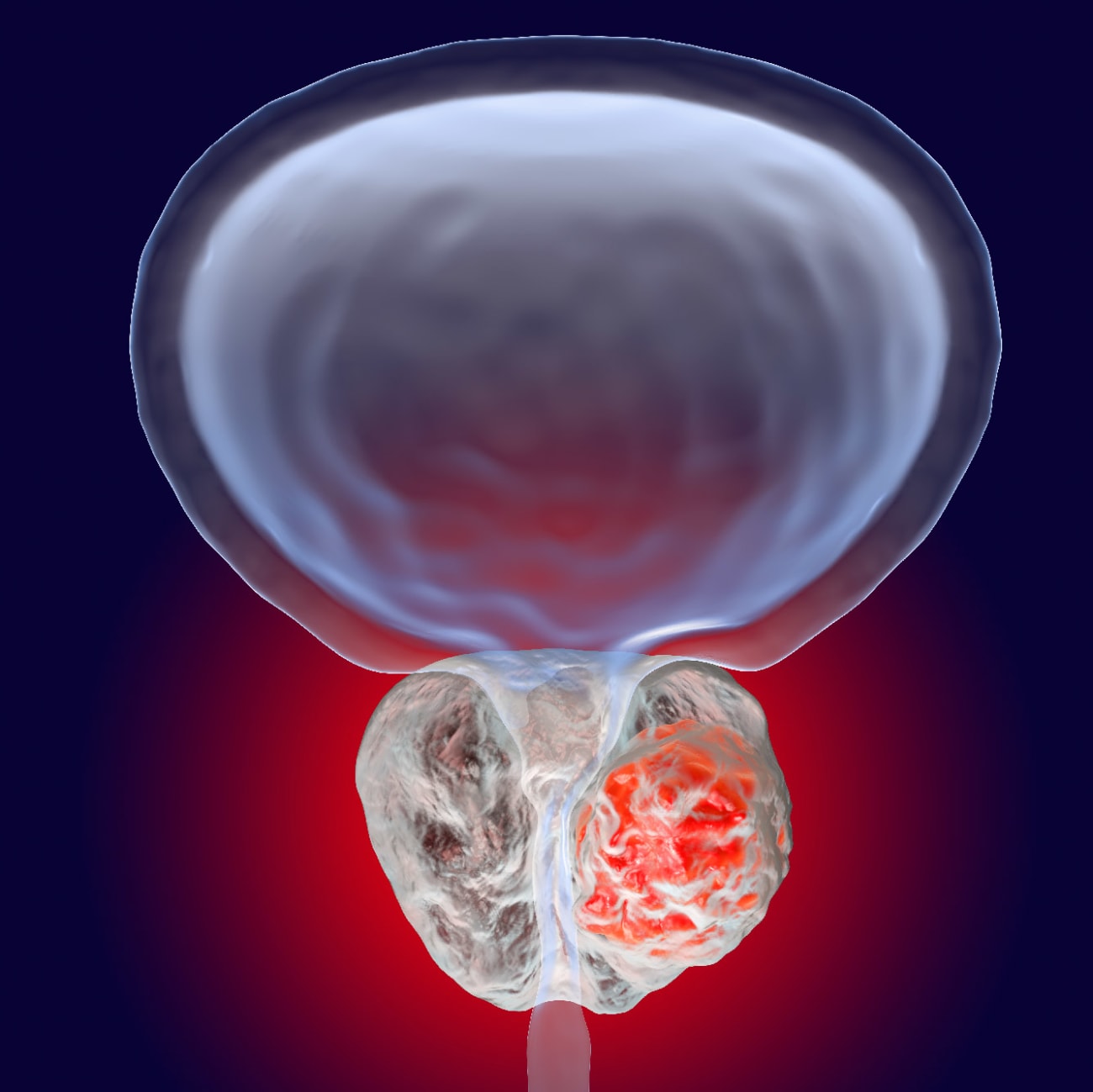 Prostate Cancer Immuno Therapy A New Target Broadcastmed