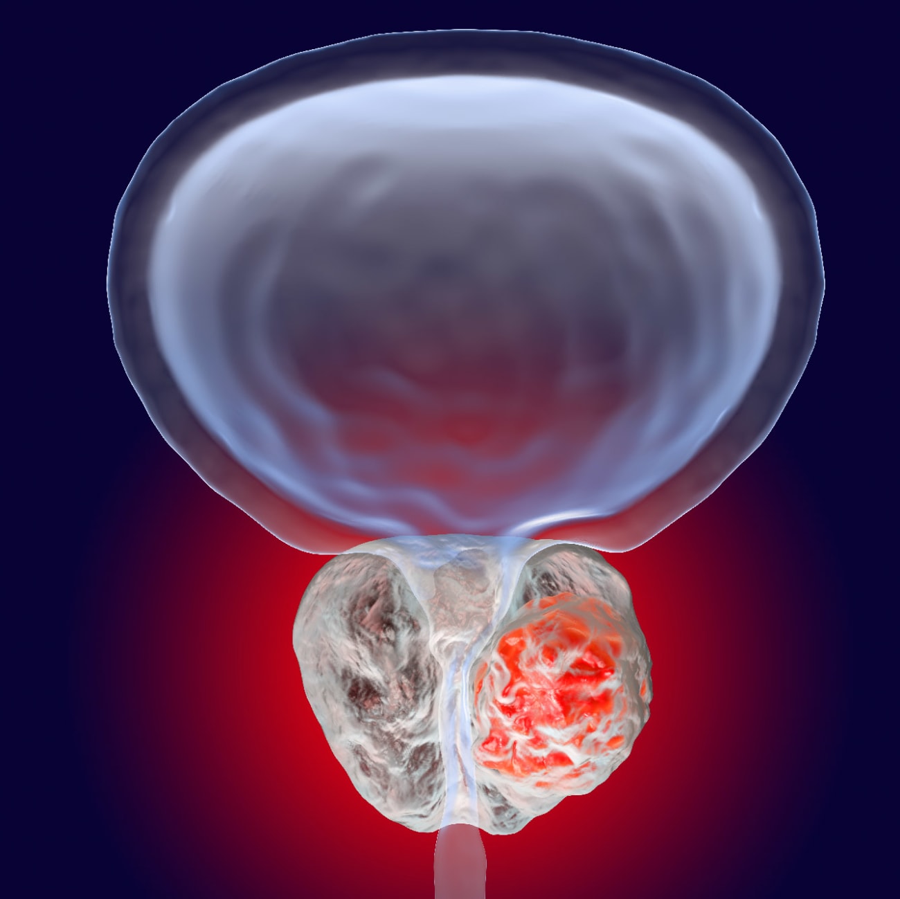Prostate Cancer Immuno therapy A New Target BroadcastMed