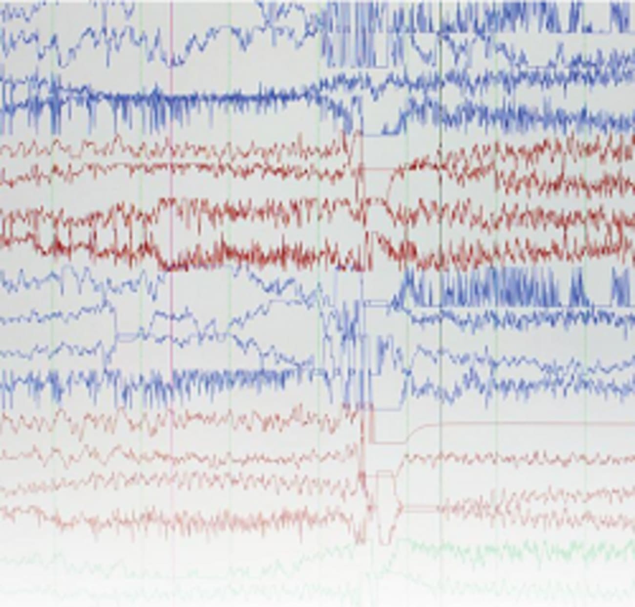 Comprehensive Care for Pediatric Epilepsy Johns Hopkins Medicine