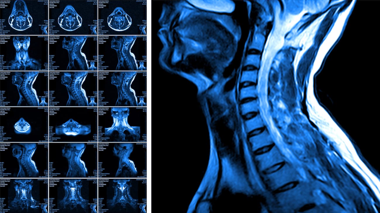 POTS and Spinal CSF Leaks Johns Hopkins Medicine