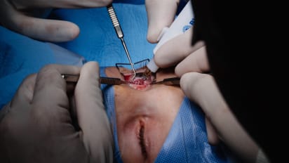 Bilateral fornix and bilateral medial rectus recession with fixed attachment for right eye and hang-back technique in left eye