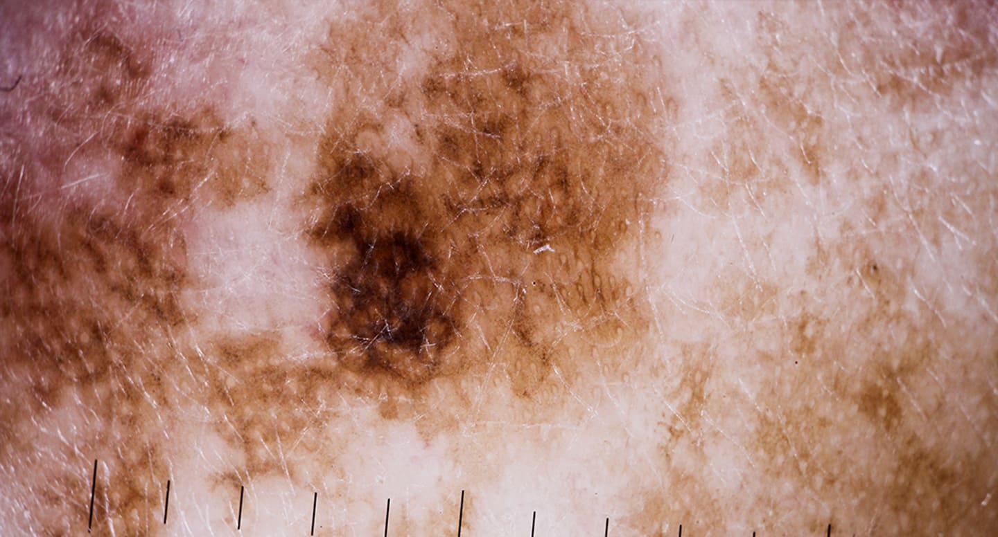 Malignt melanom på kinden i dermatoskop