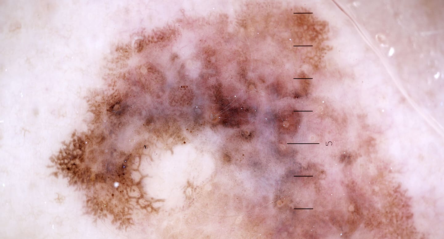 Malignt melanom oregelbunden brun fläck i dermatoskop