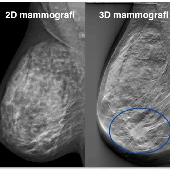 Två mammografibilder på bröst