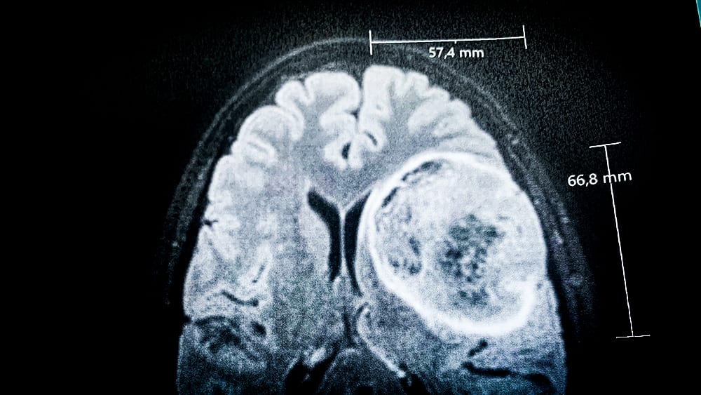Röntgenbild där hjärntumören syns på vänster sida.