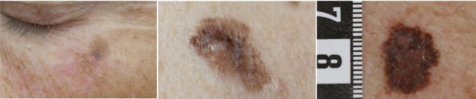 Tre olika typer av malignt melanom