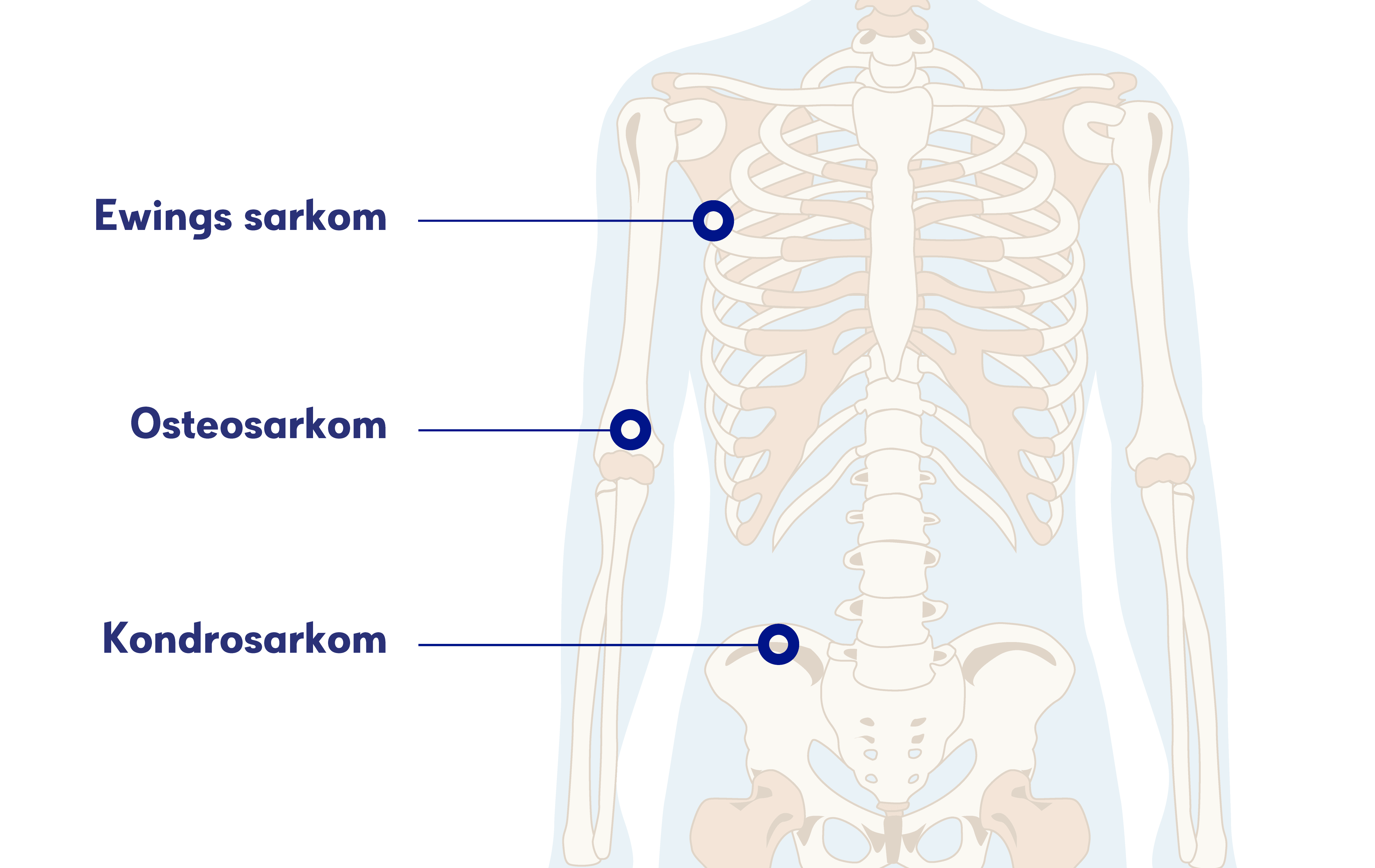 Illustration sarkom och skelett