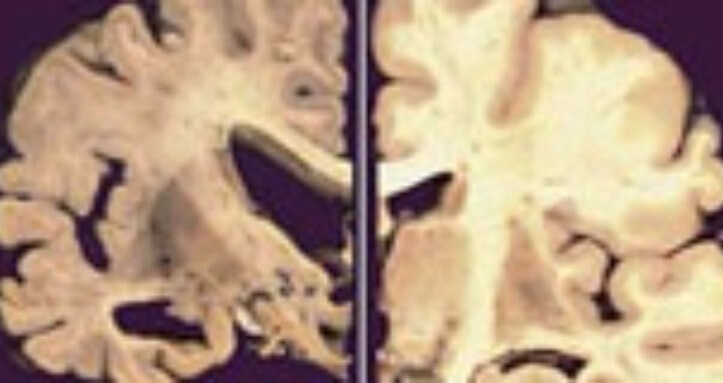 Terapia Hormonal feminina e proteção na Doença de Alzheimer