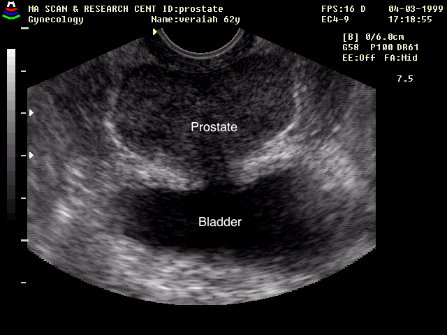 screen grab of a US transrectal image