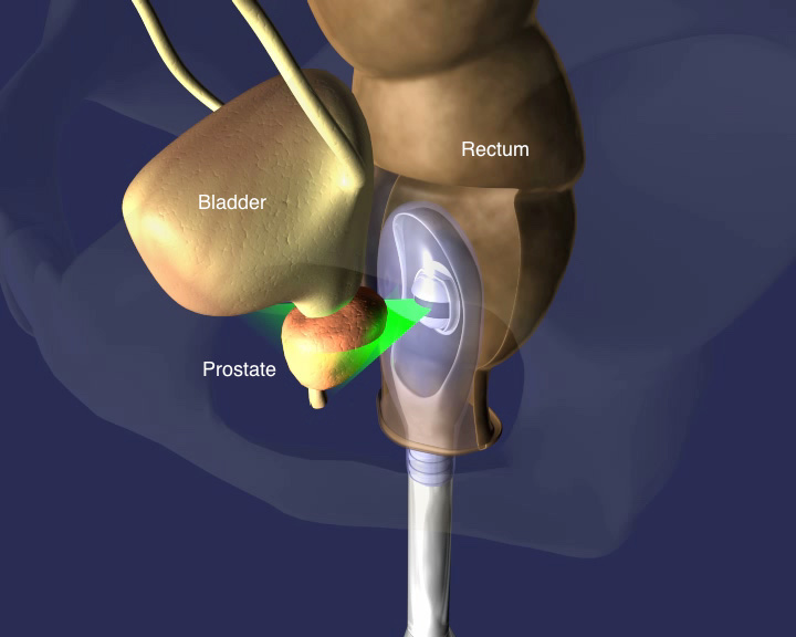 illustration of the view from a transrectal transducer
