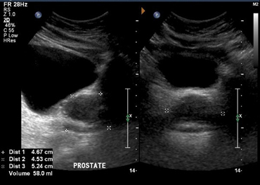 Sagittal view. prostate outlined by cross-hairs.