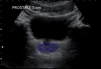 Tranverse view - prostate shown here in blue
