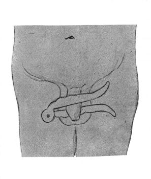 circoncision
