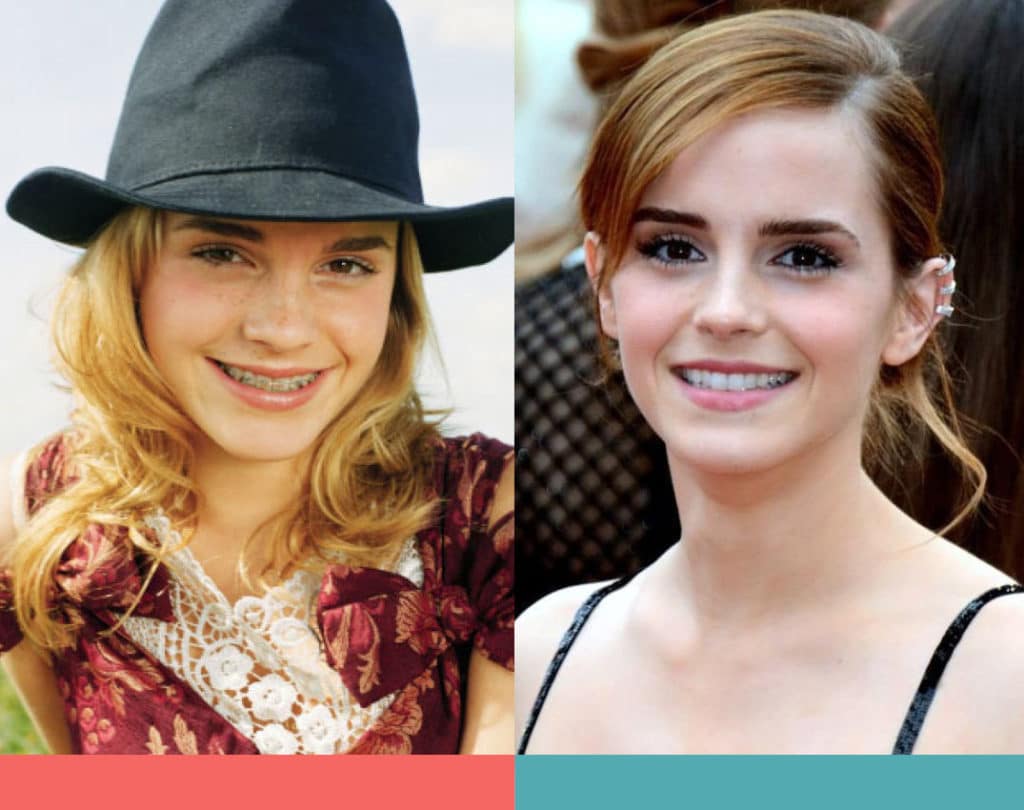 Before and After bracers3