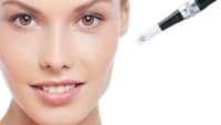 Microneedling treatment