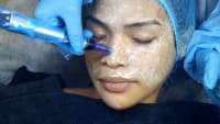 BB Glow Microneedling Training