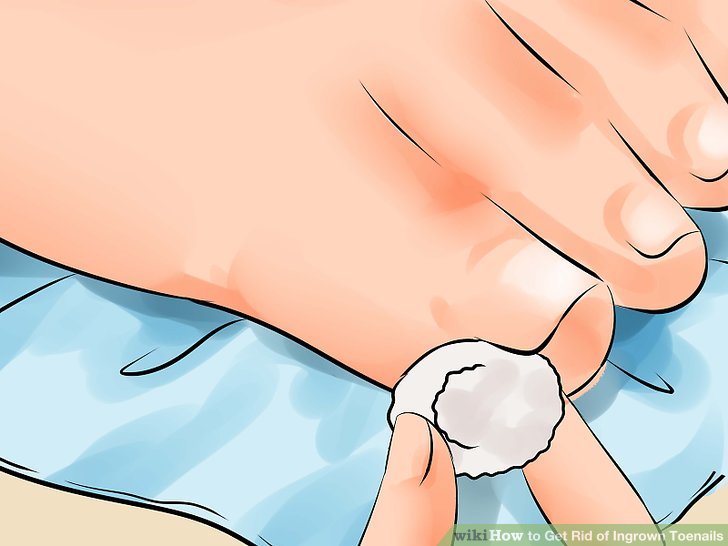 Image titled Remove an Ingrown Toenail Step 6