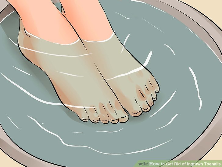 Image titled Remove an Ingrown Toenail Step 15