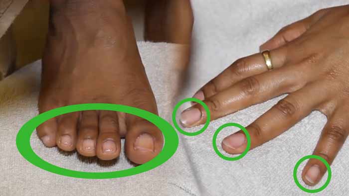 Fingernails and Toenails-dents-pitting