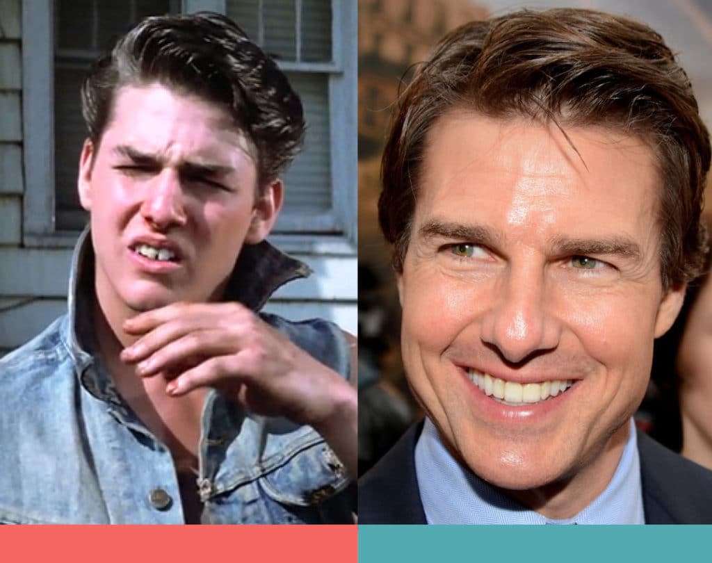 Celebrities with braces: Before and After