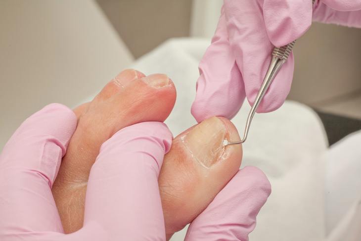 fixing-nails