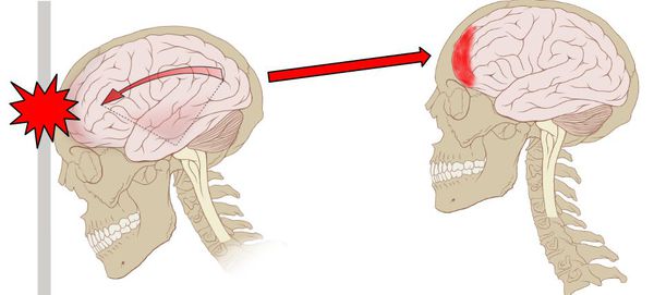 Ушиб головного мозга