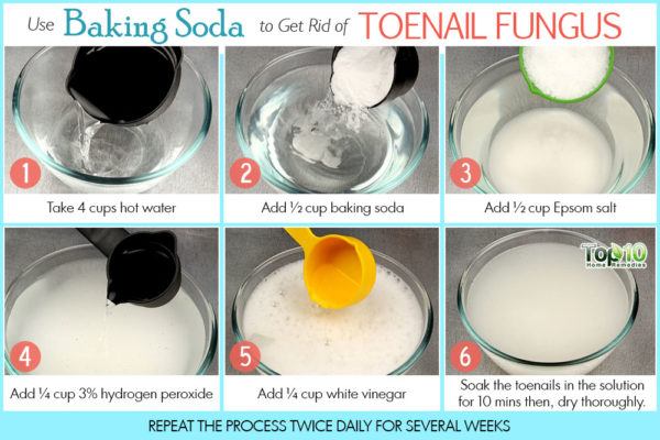 baking soda to treat toenail fungus